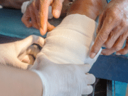 Celulitis bacteriana: Más allá de una herida