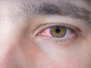 Protéjase de la conjuntivitis