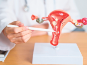 Llamado a realizarse la prueba de cáncer del cuello uterino