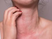 Atención con la alergia a los mariscos