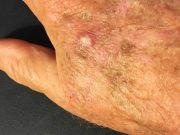 Estadísticas revelan aumentan casos de melanoma