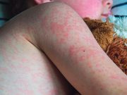 Resurge el sarampión: ¿Qué debo conocer?