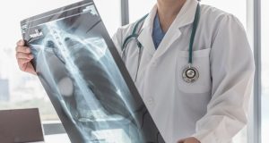 Cáncer de pulmón: una batalla que se puede ganar con detección temprana