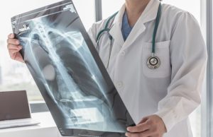 Cáncer de pulmón: una batalla que se puede ganar con detección temprana