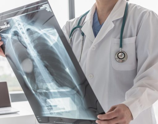 Cáncer de pulmón: una batalla que se puede ganar con detección temprana