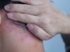 Psoriasis: cómo afecta y qué hacer para proteger su piel