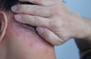 Psoriasis: cómo afecta y qué hacer para proteger su piel