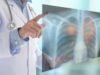 Cáncer del pulmón: Reto para la oncología