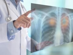 Cáncer del pulmón: Reto para la oncología