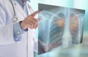 Cáncer del pulmón: Reto para la oncología