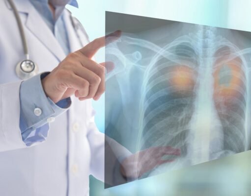 Cáncer del pulmón: Reto para la oncología